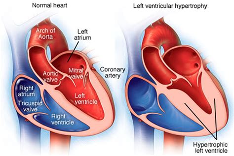 left ventricular lv|left ventricular prominence.